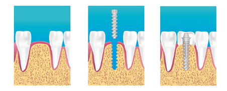 implant dentaire strasbourg